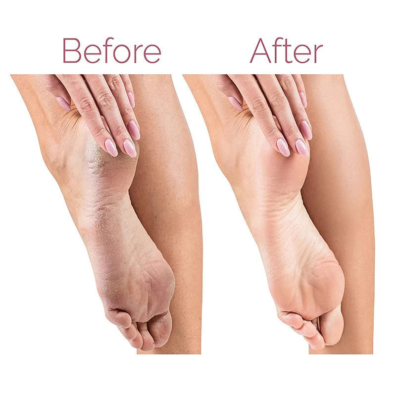 Electric Pedicure Foot File Callus Remover, Rechargeable Foot Care Tool